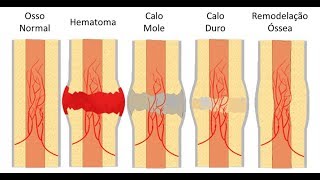 Consolidação Óssea das Fraturas FASES do CALO ÓSSEO  Clínica de Fisioterapia Dr Robson Sitta [upl. by Wilmar]