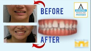 Invisalign Before and After Gap in Teeth [upl. by Ffej]