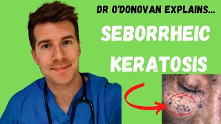 Explaining Seborrheic Keratosis  With Dr ODonovan [upl. by Ayatahs]