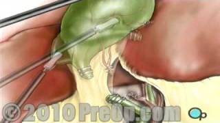 Gallbladder Removal Laparoscopic PreOp® Patient Education [upl. by Robbyn810]