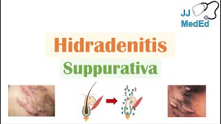 Hidradenitis Suppurativa HS  Pathophysiology Triggers Signs amp Symptoms Diagnosis Treatment [upl. by Barnet]