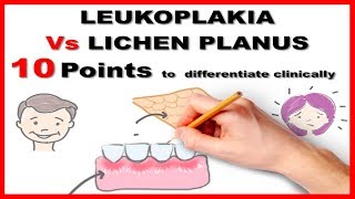 How to clear white patch in the mouth  LASER SURGERY FOR LEUKOPLAKIA LIVE SURGERY [upl. by Laitselec]