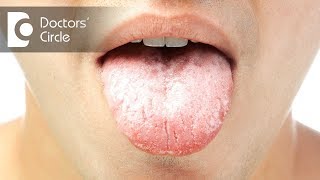 Leukoplakia l Precancerous lesions l Oral pathology l Mediklaas [upl. by Sedruol]