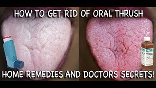 How to Treat Candida at Home Doctors Advice [upl. by Horace208]