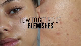 HOW TO GET RID OF BLEMISHES IN 3 DAYS  Jessicvpimentel [upl. by Auhoj]