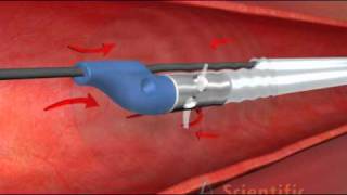 Thrombectomy Catheter  3D Medical Animation [upl. by Eiramlirpa]