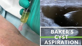 Simple Bakers Cyst Aspiration [upl. by Bronny397]