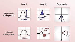 Intro to EKG Interpretation  Chamber Enlargement [upl. by Dickenson]