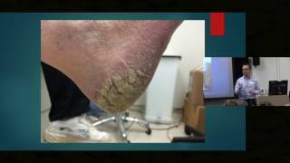 Itch in Elderly Skin  Dr Ian Bekker [upl. by Auqenahs22]