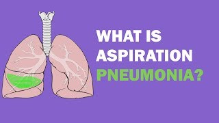 Needle Aspiration of a Pneumothorax [upl. by Eshelman]