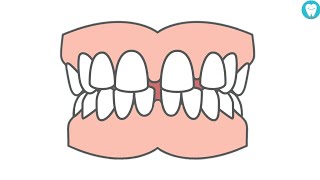 How To Close Gaps Between Teeth Without Braces [upl. by Eva]