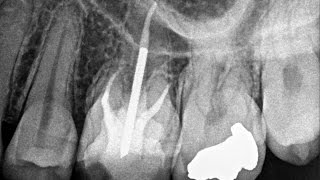 Root canal treatment tooth 14 [upl. by Devine]