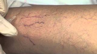 Spider Vein Sclerotherapy [upl. by Kalina]