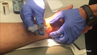 Simultaneous Carpal and Cubital Tunnel releases  CTR Injection [upl. by Enillebyam]