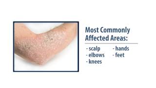 Common Skin Disorders Eczema amp Psoriasis [upl. by Nosrej958]